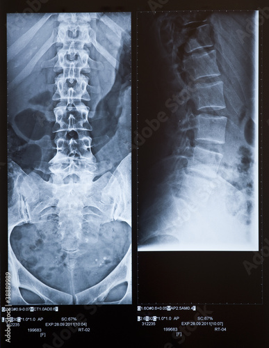 Photo: Back X-ray including coxis and pelvis. 2 views. Female. Back X-ray including coxis and pelvis. 2 views. Female.