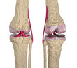 Osteoarthritis : Knee joint with ligaments and cartilages