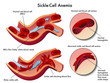 anemia falciforme