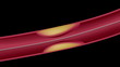 Video: Balloon angioplasty procedure Balloon angioplasty procedure