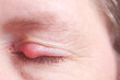 Geschlossenes Auge mit Gerstenkorn