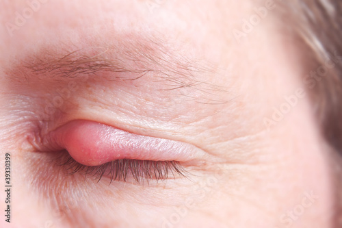 Foto: Geschlossenes Auge mit Gerstenkorn Geschlossenes Auge mit Gerstenkorn