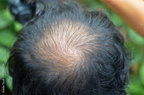 Photo: A crater in the middle of the head A crater in the middle of the head