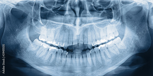Foto: X-ray scan of teeth X-ray scan of teeth