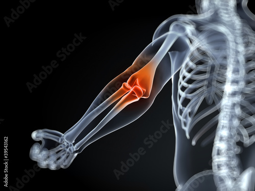 Illustration: 3d rendered medical illustration of an elbow bursitis 3d rendered medical illustration of an elbow bursitis