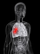 3d rendered scientific illustration of a lung tumor
