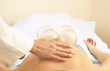 Woman receiving vacuum cupping treatment