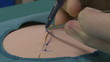 Surgeon exercising stitches removal