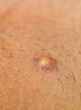 Pimple Extreme Macro