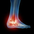 Ankle Foot Pain