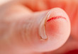 injured finger