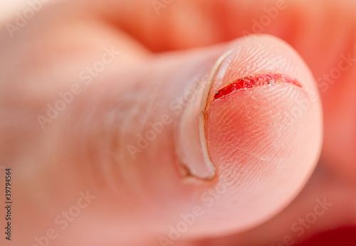 Photo: injured finger injured finger
