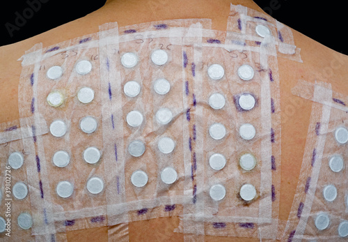 Photo: Skin Allergy Test Skin Allergy Test