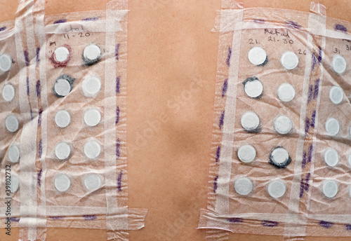 Photo: Skin Allergy Test Skin Allergy Test