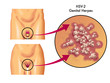 herpes genitale