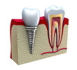 Illustration: Anatomy of healthy teeth and dental implant in jaw bone. Anatomy of healthy teeth and dental implant in jaw bone.