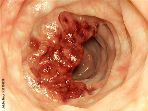 Illustration: Darmtumor / intestine tumor Darmtumor / intestine tumor