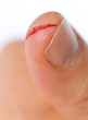 Photo: injured finger injured finger
