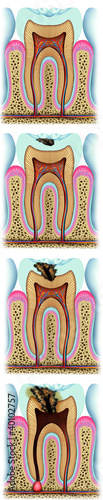 Illustration: Stages of Carie Stages of Carie