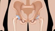 Total hip replacement surgery