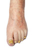 Fungal Nail Infection