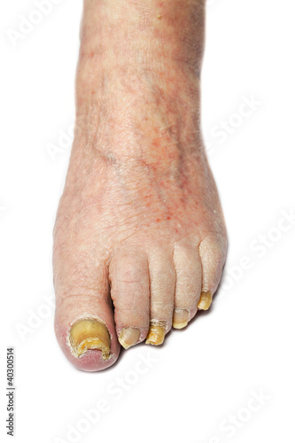 Photo: Fungal Nail Infection Fungal Nail Infection