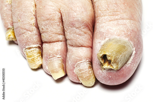 Photo: Fungal Nail Infection Fungal Nail Infection