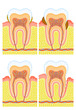 Internal structure of tooth: dental calculus, decay
