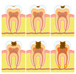 Internal structure of tooth: decay and caries