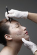 Woman has her face drawn around her eye in preparation for cosmetic surgery