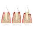 parodontitis tooth plaque vector illustration