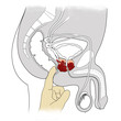 prostate cancer