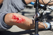 bike fall injury