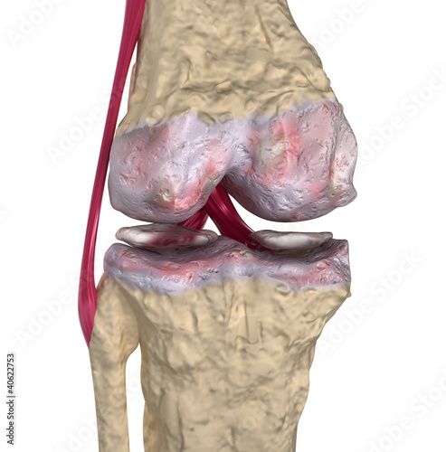 Illustration: Osteoarthritis : Knee joint with ligaments and cartilages Osteoarthritis : Knee joint with ligaments and cartilages