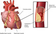 Human Heart Coronary Problem with Cholesterol Plaque Build up