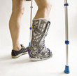 Man with a broken leg with Orthotic