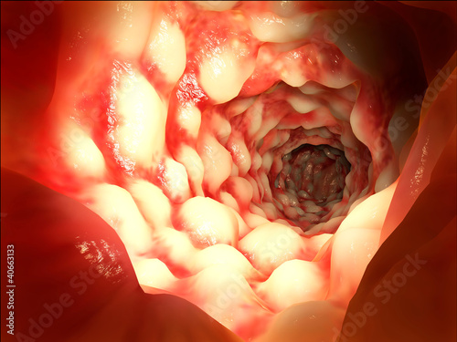 Illustration: Darm mit Morbus Crohn Darm mit Morbus Crohn