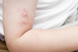 Herpes zoster.