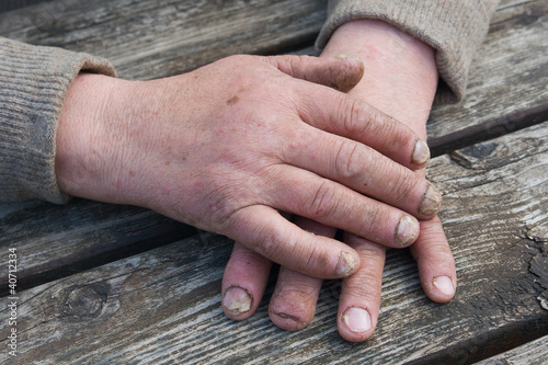 Photo: Fungal Nail Infection Fungal Nail Infection