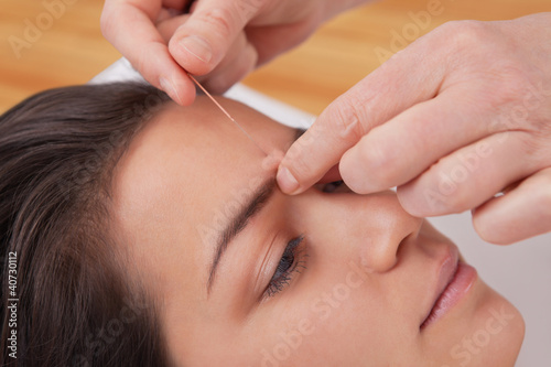 Photo: Acupuncture needles on head Acupuncture needles on head
