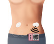 Illustration of insulin pump & CGM (Artificial Pancreas)