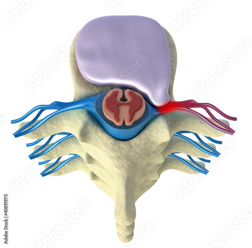 Illustration: Prolapse of intervertebral disc. Top view Prolapse of intervertebral disc. Top view