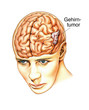 Gehirntumor.Gewebswucherung