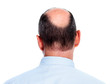 Hair loss. Bald man.
