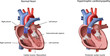 Heart Problem Hypertrophic Cardiomyopathy Vector Illustration.