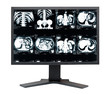 Medicalmonitor. MRI tomogram of human kidney