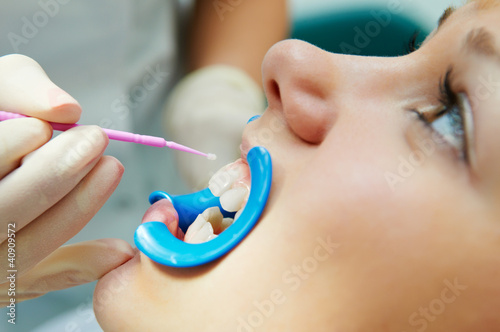 Photo: dental procedure of teeth protecting dental procedure of teeth protecting