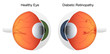 Illustration of hemorrhage in retina - Diabetic Retinopathy Illustration of hemorrhage in retina - Diabetic Retinopathy