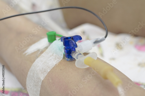 Photo: catheter into the vein. introduction of preparations. catheter into the vein. introduction of preparations.