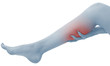 Acute pain in a woman calf